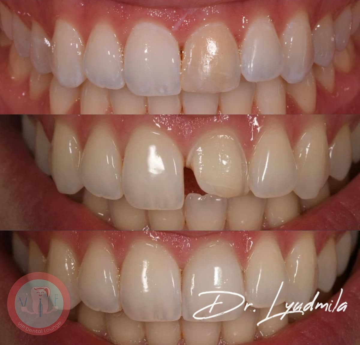 Smile makeover before and after at VIP Dental Lounge in Portage Park