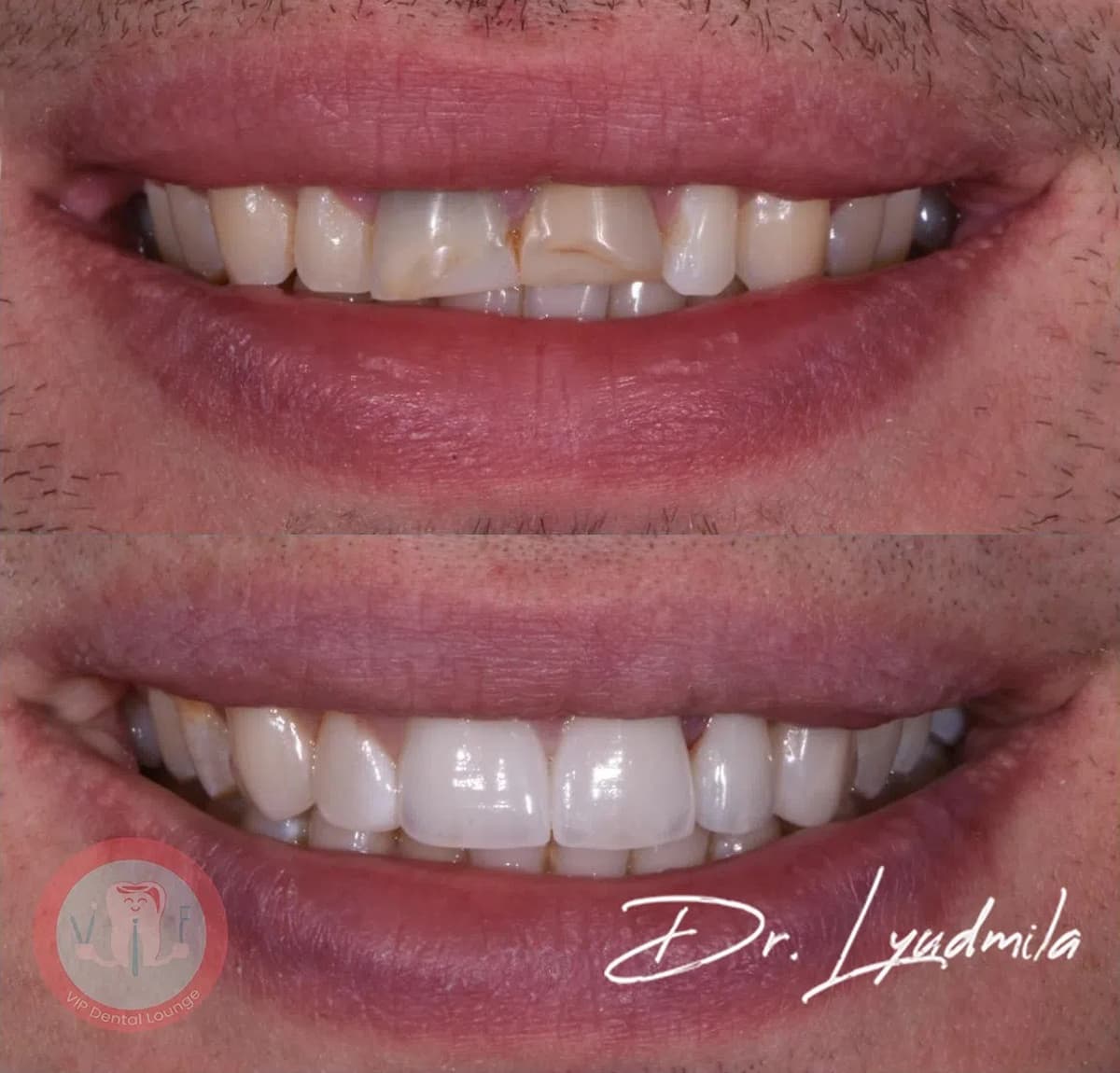 Smile makeover before and after — case 1