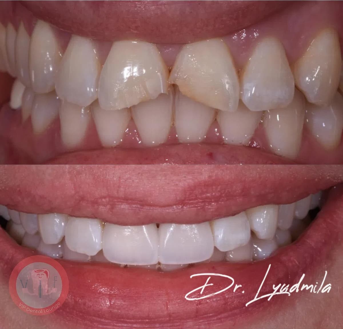 Smile makeover before and after — case 2