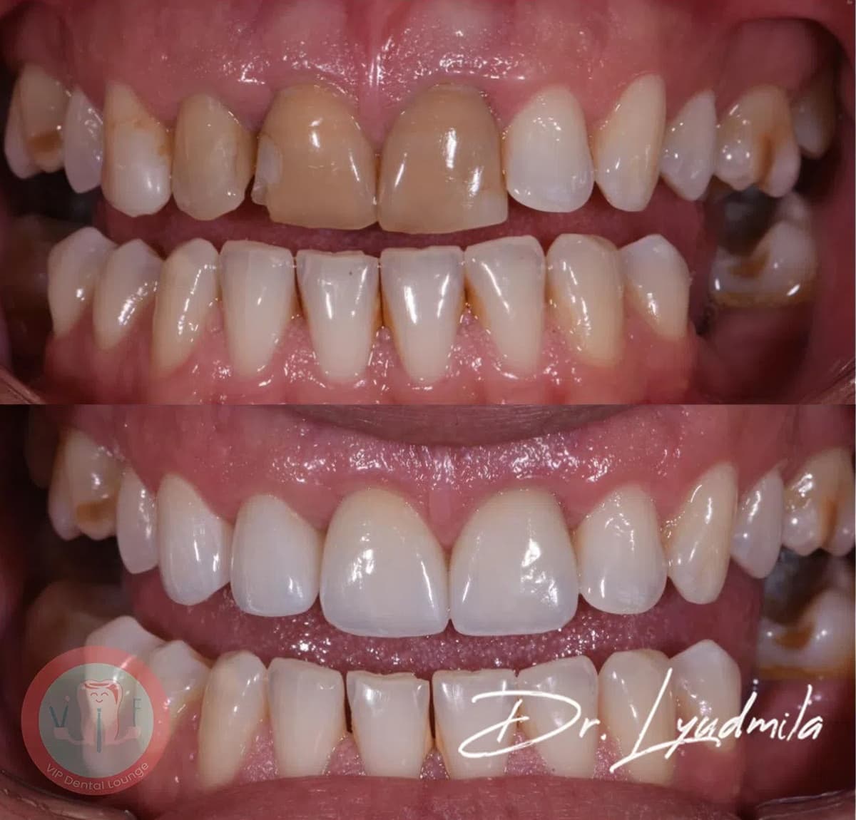 Smile makeover before and after — case 3