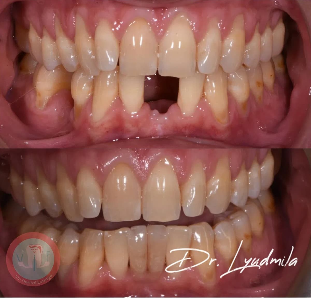 Smile makeover before and after — case 4