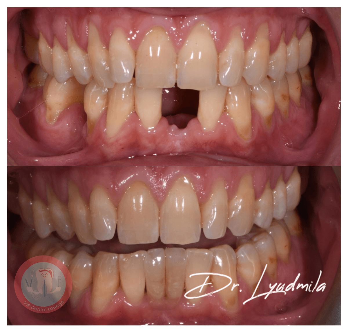Porcelain veneers before and after — case 9