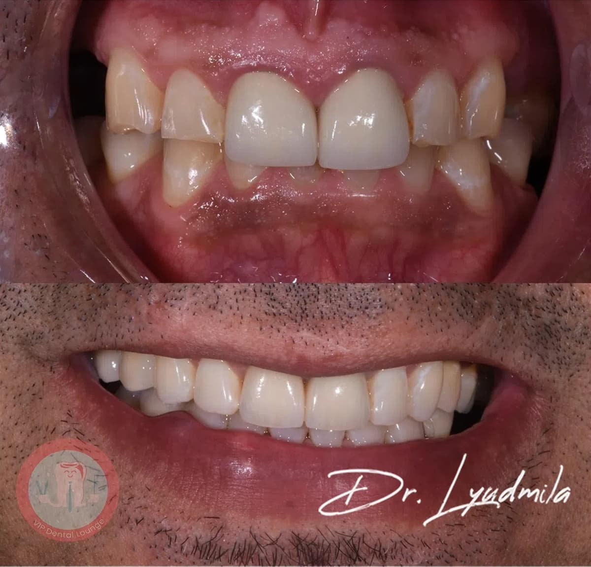 Smile makeover before and after — case 5