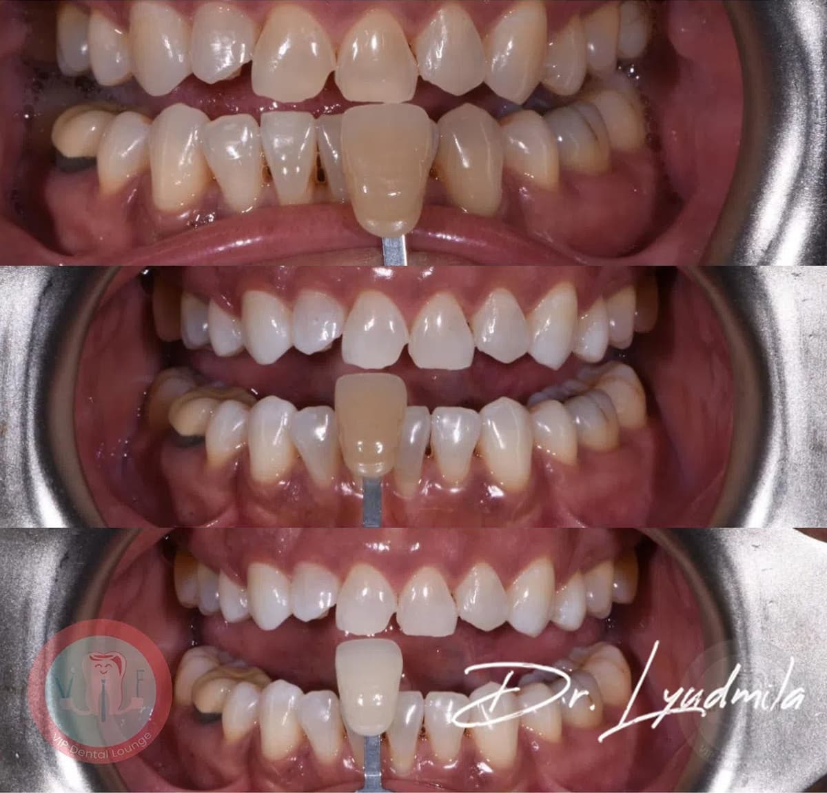 Smile makeover before and after — case 6