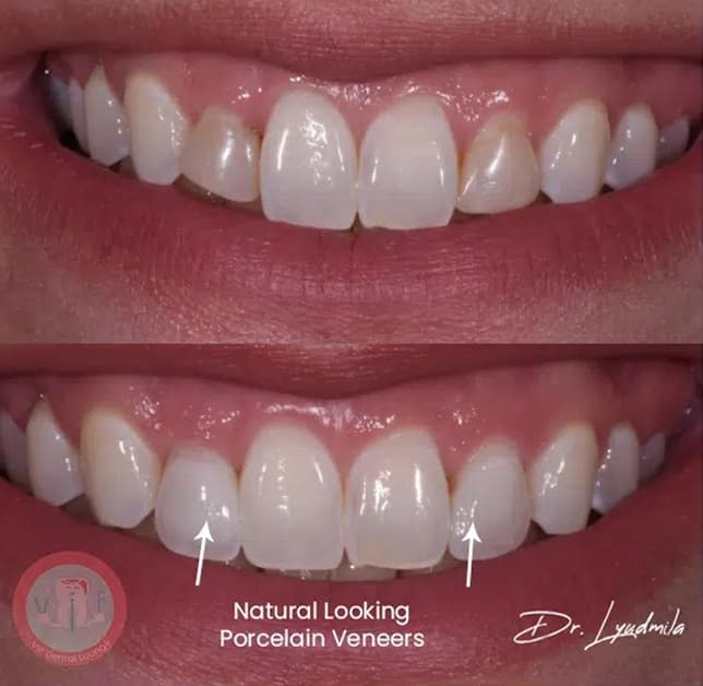 Porcelain veneers before and after — case 8