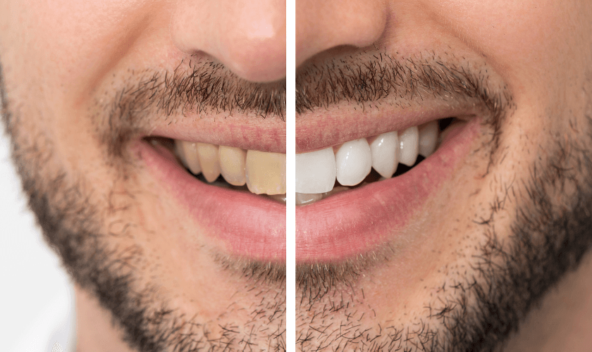 Get Your Smile Ready For Valentine’s Day: Top Professional Teeth Whitening Tips