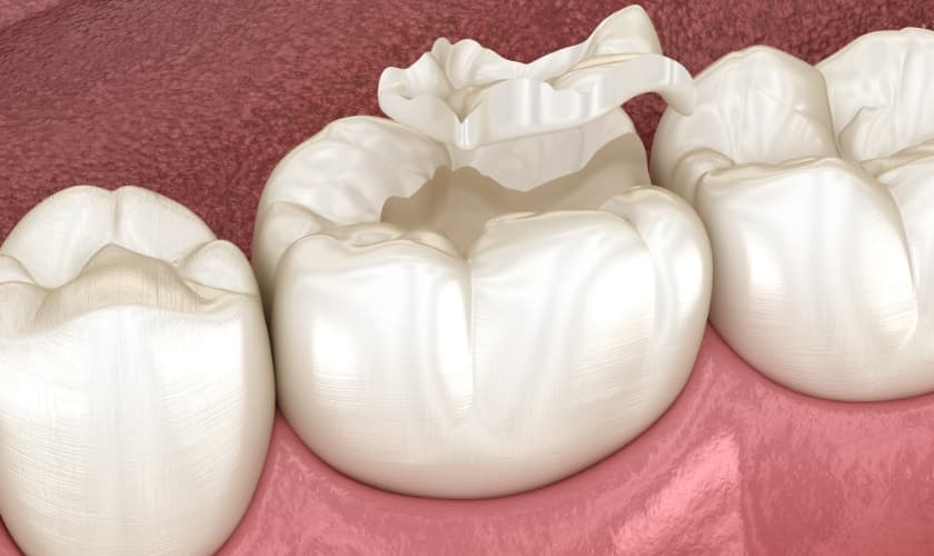 How Long Do Tooth Onlays Last? A Comprehensive Guide