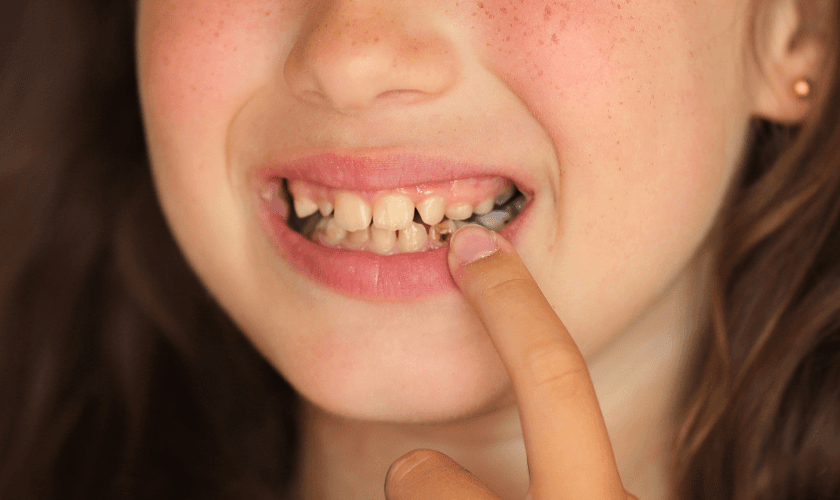 The Link Between Tooth Cavities and Cancer