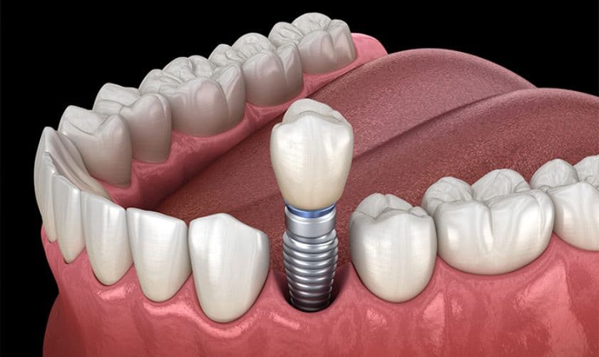 explain dental implants with module at VIP Dental Lounge