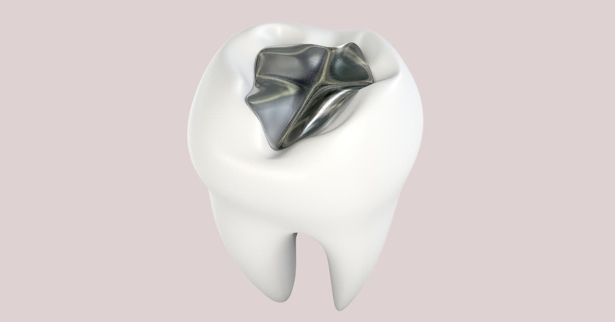 How Dental Sealants Help Protect Your Smile