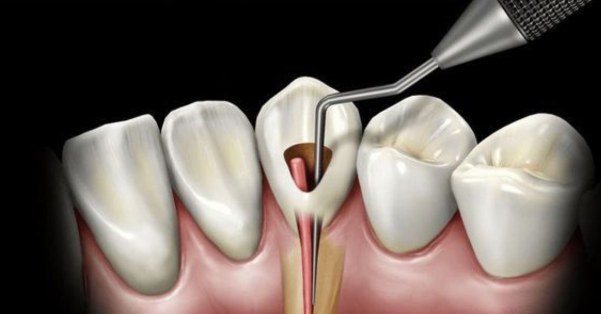 ten signs you might need a root canal surgery