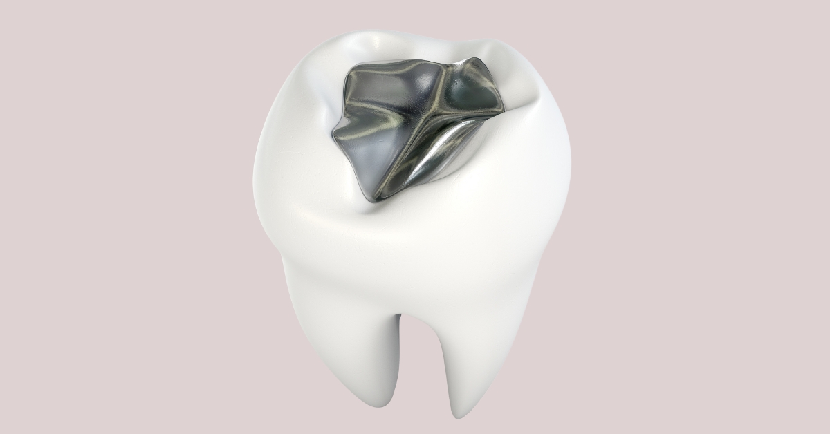 How Dental Sealants Help Protect Your Smile