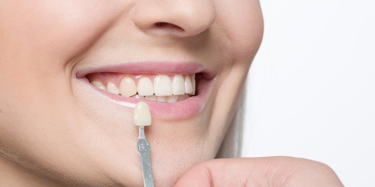 essential tips to maintain your veneers over time