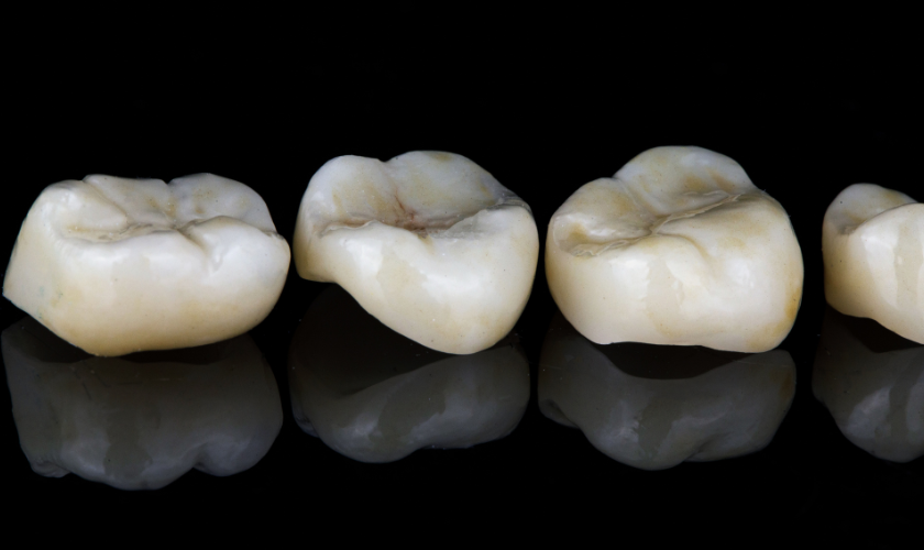 Filling, Inlay, Onlay, or Crown? What is the Difference?